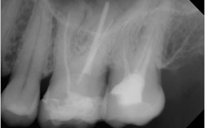 img diagnostik wurzelfuellung 1