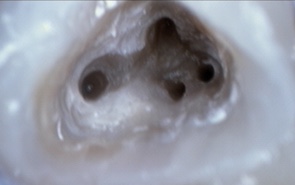 img diagnostik wurzelfuellung 2