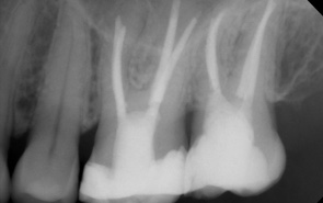 img diagnostik wurzelfuellung 3
