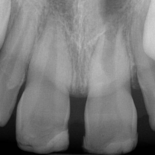 FZ-Trauma im Alter von 9 Jahren mit Recall nach 22 Monaten