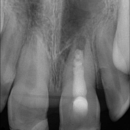 FZ-Trauma im Alter von 9 Jahren mit Recall nach 22 Monaten