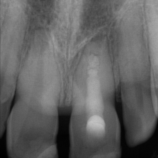 FZ-Trauma im Alter von 9 Jahren mit Recall nach 22 Monaten