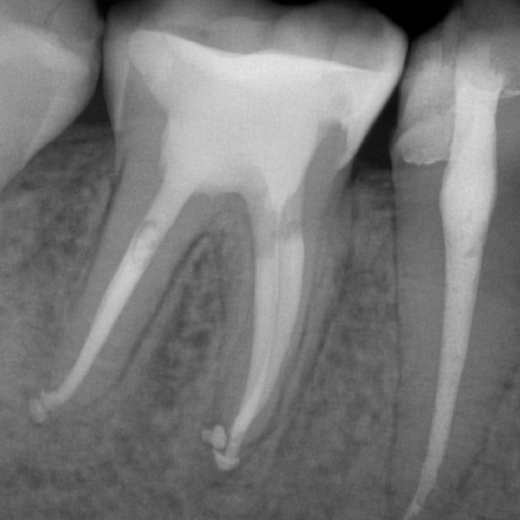 Revision 46 (und 45) Recall 6 Monate