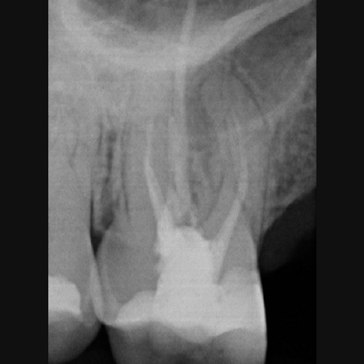 11494: Molarenrevision mit Seitenkanal