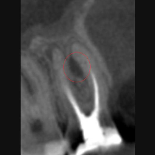 11494: Molarenrevision mit Seitenkanal