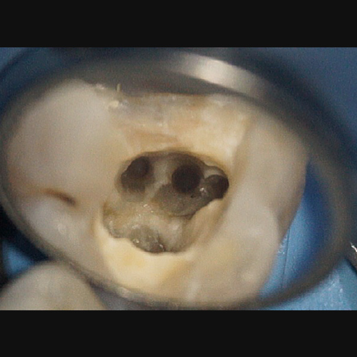 11494: Molarenrevision mit Seitenkanal