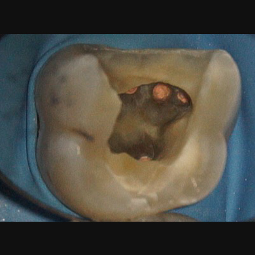 11494: Molarenrevision mit Seitenkanal