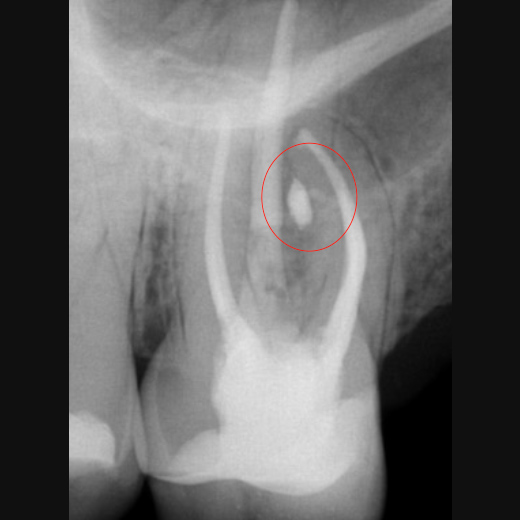 11494: Molarenrevision mit Seitenkanal