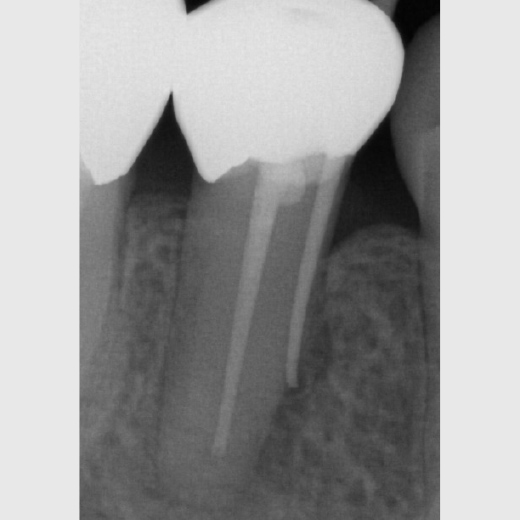 Revision 45 nach WSR Recall 30 Monate