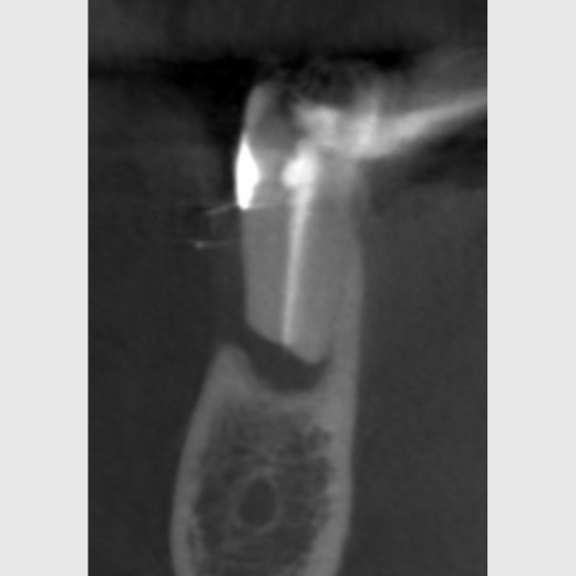 Revision 45 nach WSR Recall 30 Monate