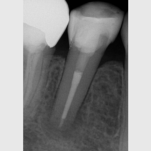 Revision 45 nach WSR Recall 30 Monate