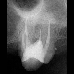 Endoberlinsued Perforation 2