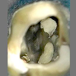 Endoberlinsued Perforation 3