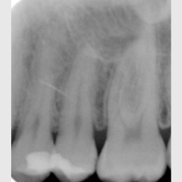 Vollständige Pulpotomie