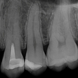 Vollständige Pulpotomie