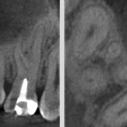 Vollständige Pulpotomie