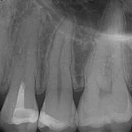 Vollständige Pulpotomie