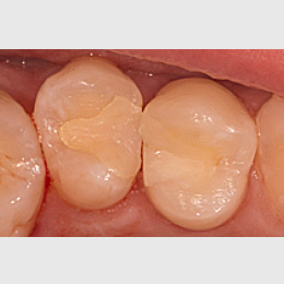 Vollständige Pulpotomie