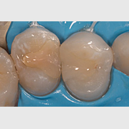 Vollständige Pulpotomie