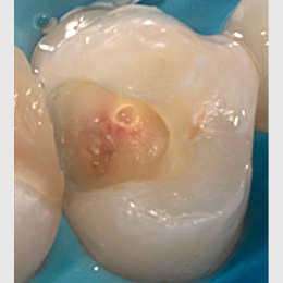 Vollständige Pulpotomie