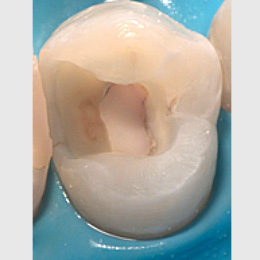 Vollständige Pulpotomie