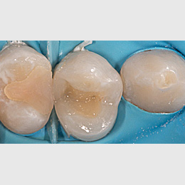 Vollständige Pulpotomie