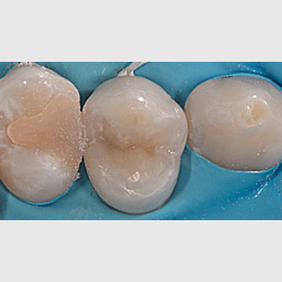 Vollständige Pulpotomie