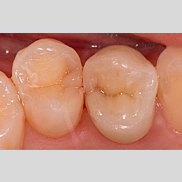 Vollständige Pulpotomie