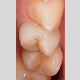 Vollständige Pulpotomie