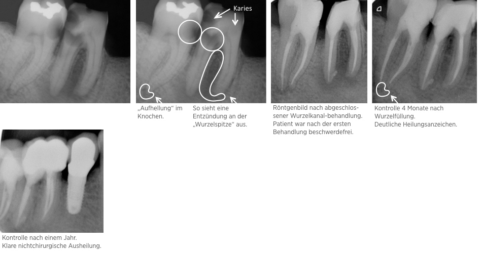 endodontie Fall