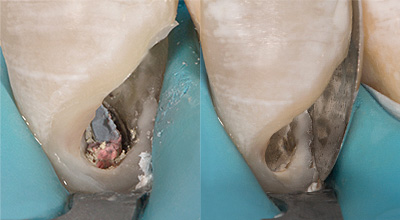 subgingivale defekte 1