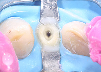 endo content kofferdam 1