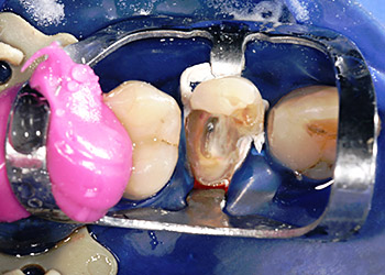 endo content kofferdam 2