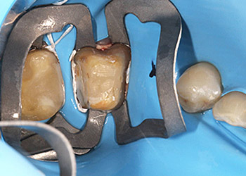 endo content kofferdam 3