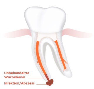 Wurzelfüllungsrevision Abb.1