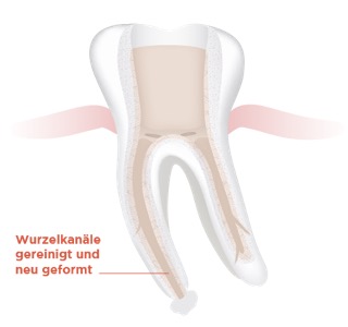 Wurzelfüllungsrevision Abb.2