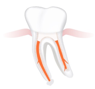 Wurzelfüllungsrevision Abb.3