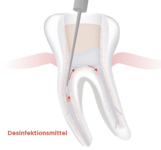 img endodontie step by step 3