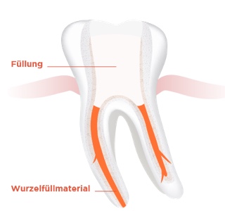 img endodontie step by step 4