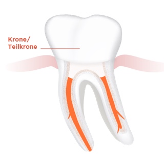 img endodontie step by step 5