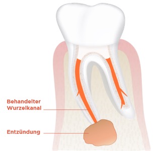 Wurzelspitzenresktion Abb. 1