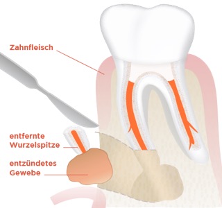 Wurzelspitzenresktion Abb. 2