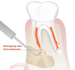 Wurzelspitzenresktion Abb. 3
