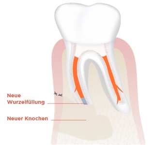 Wurzelspitzenresktion Abb. 4